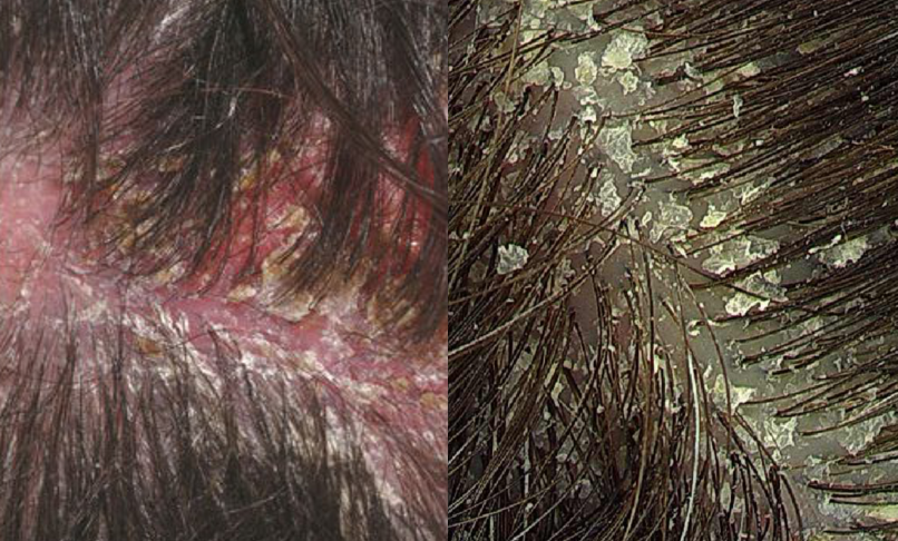 Best Scalp Dryness and Dandruff Treatment for men women, cost in mumbai, india