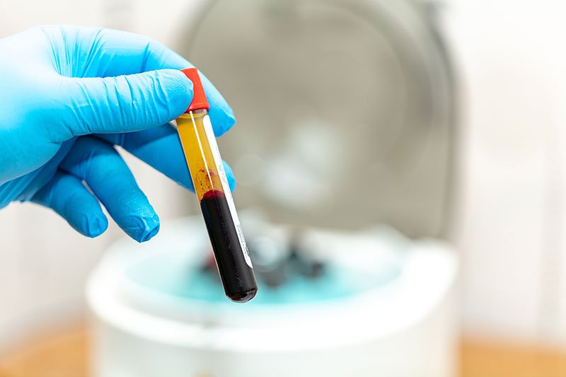 PRP Treatment